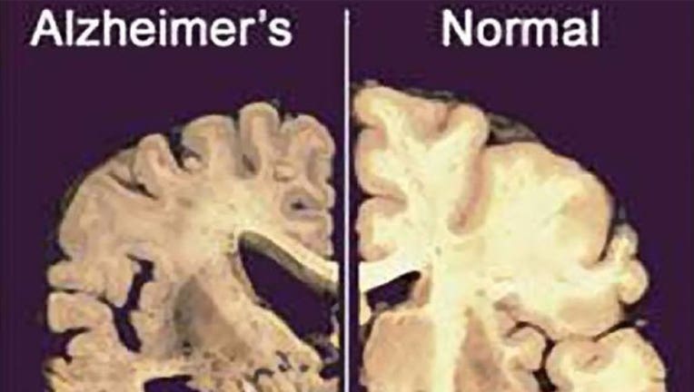 alzheimer's-vs-normal_1460667230946-407693.jpg