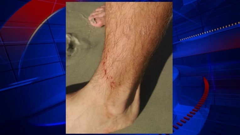 Boy, 14, bitten on foot by shark in New Smyrna Beach