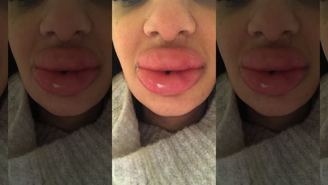 Dentist left with swollen 'lumps' in lips after seeking cheap fillers