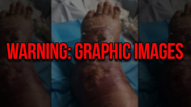Woman contracts flesh-eating bacteria after insect bite, nearly loses foot: 'I felt like I had been stabbed'