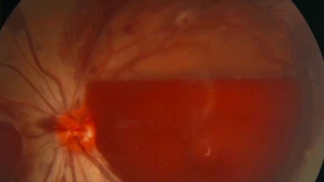 Woman temporarily blinded after excessive smart phone use, report says