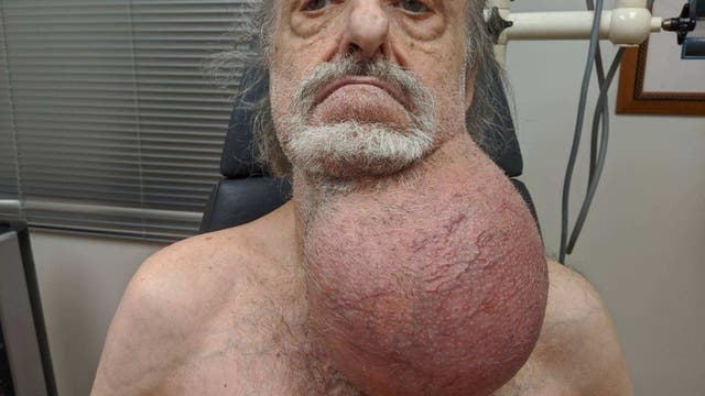 New Jersey man has tumor size of his head removed from neck