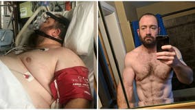 Iowa man sheds half his body weight after invasive spinal surgery, says he once ate 'with no constraint'