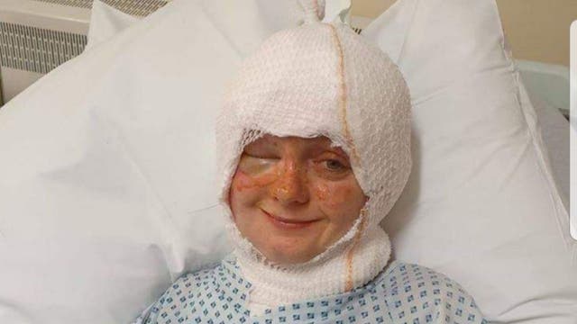 Woman suffers severe burns after hair catches fire as she was blowing out a candle