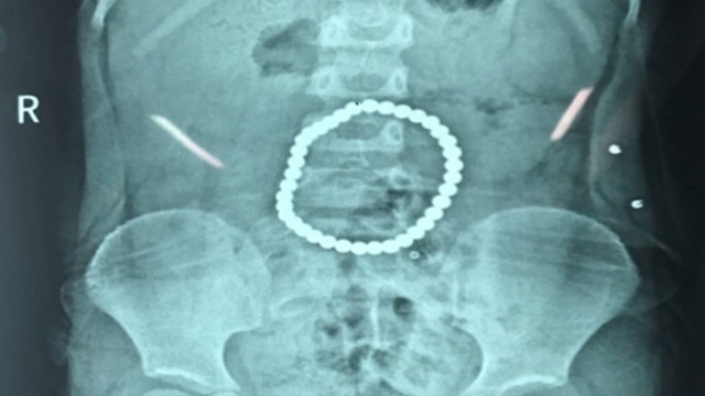 Toddler left with holes in stomach after swallowing 37 magnetic balls, report says