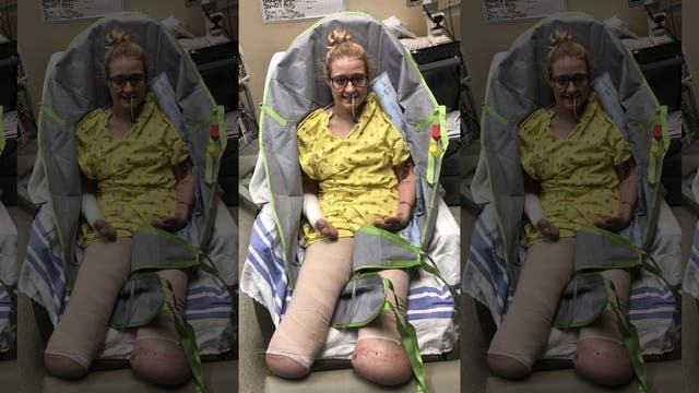 Mom loses legs, nearly all fingers after contracting deadly sepsis infection: 'Small price to pay for my life'