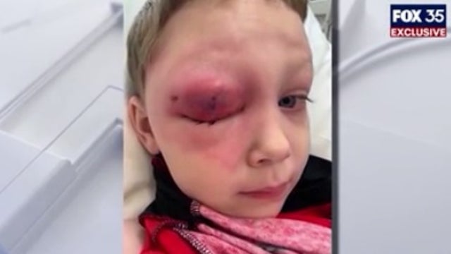 FOX 35 EXCLUSIVE: Central Florida boy with serious eye infection on cruise finally returns home