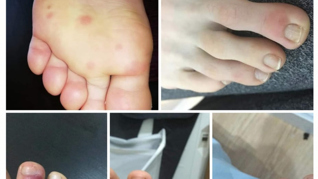 Researchers discover new coronavirus symptoms: feet lesions