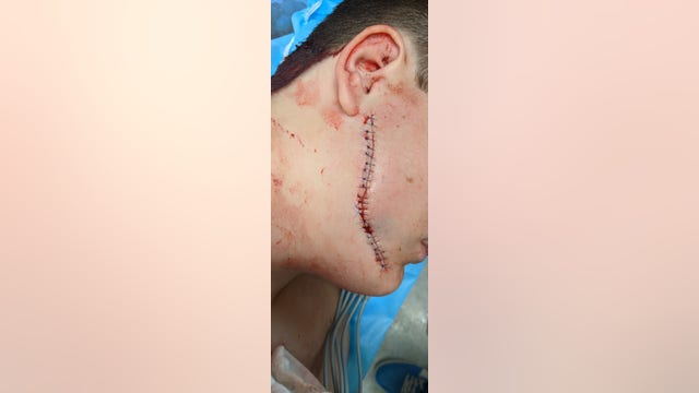 Teen allegedly slashed in face by stranger in Orange City