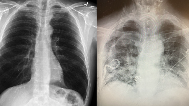 Texas surgeon noticing some post-COVID-19 lungs have more scar tissue than smokers’ lungs