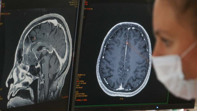 Extended brain fog may be a common symptom after COVID-19 infection, according to study