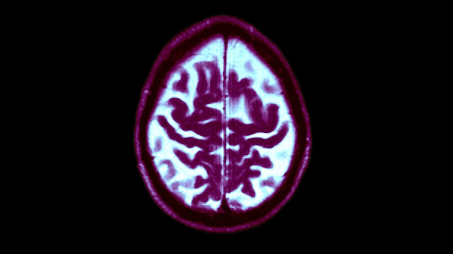 Brain Alzheimer’s1