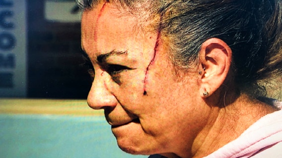 DeBary woman attacked by a bear shares terrifying story with FOX 35