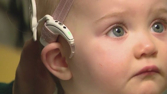 Cochlear implants give toddler gift of hearing