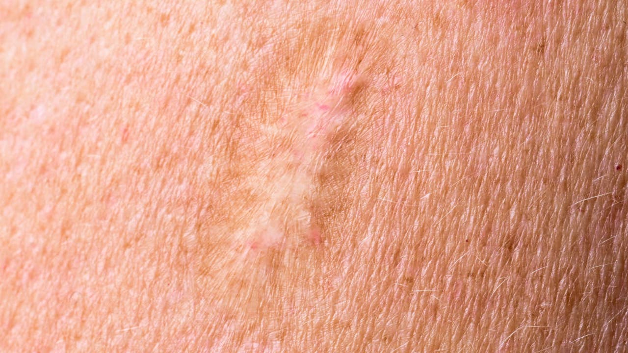 Smallpox vaccine Jynneos can prevent monkeypox, CDC says - Vimarsana News