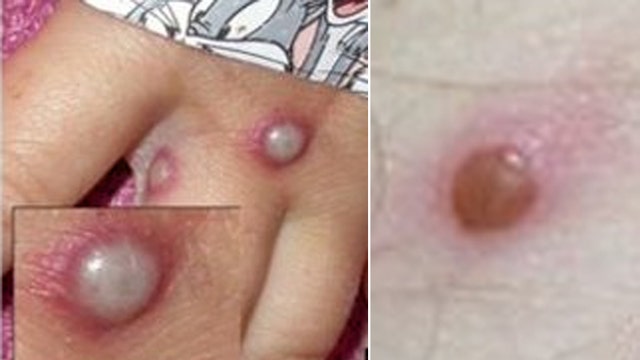 Monkeypox in Florida: State has the 3rd highest confirmed cases in the U.S.