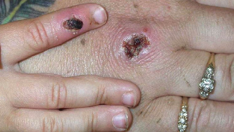 Monkey Pox Lesions