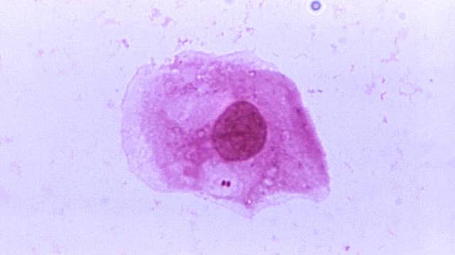 CDC monitoring outbreak of Meningococcal disease in Florida: The symptoms to watch for