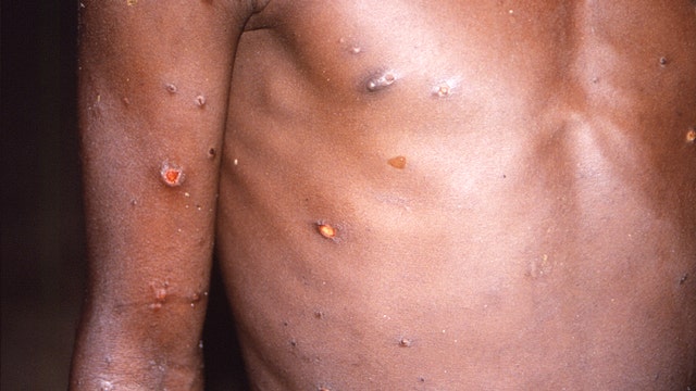 Monkeypox in Florida: Two more confirmed cases in Central Florida, health department says