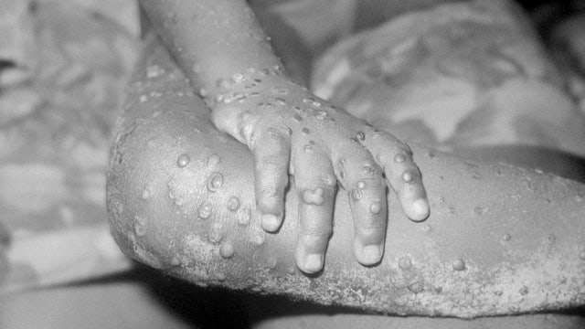 Monkeypox in Florida: Monitoring continues as cases reach nearly 250