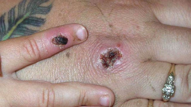 Monkeypox case connected to Wedgefield School, Orange County Public Schools confirm