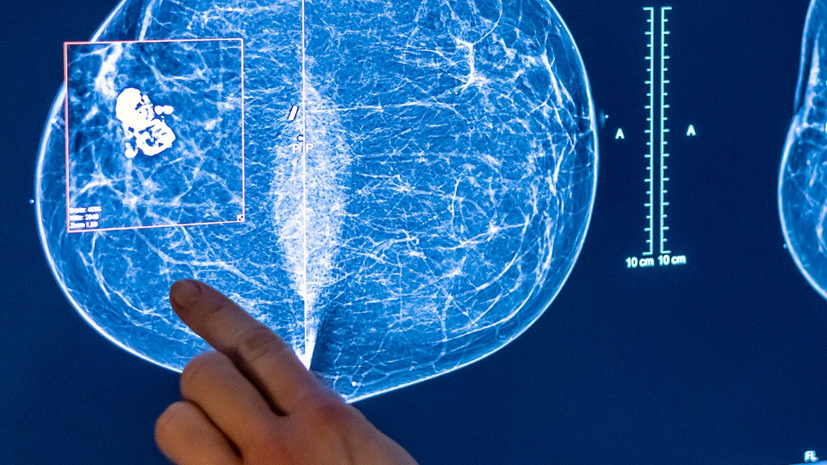 Inside the Mammogram Experience: Patient, radiologist explain what screening is really like