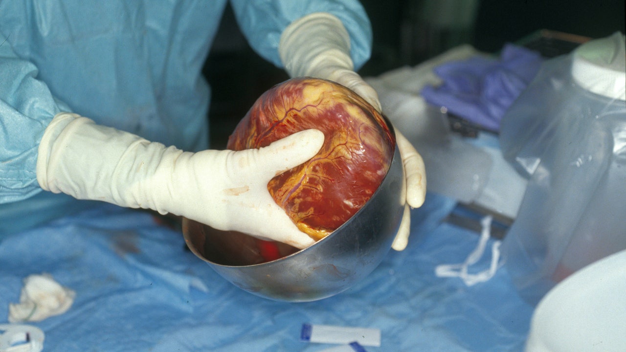 New heart transplant method could expand donor hearts by 30% - Vimarsana News