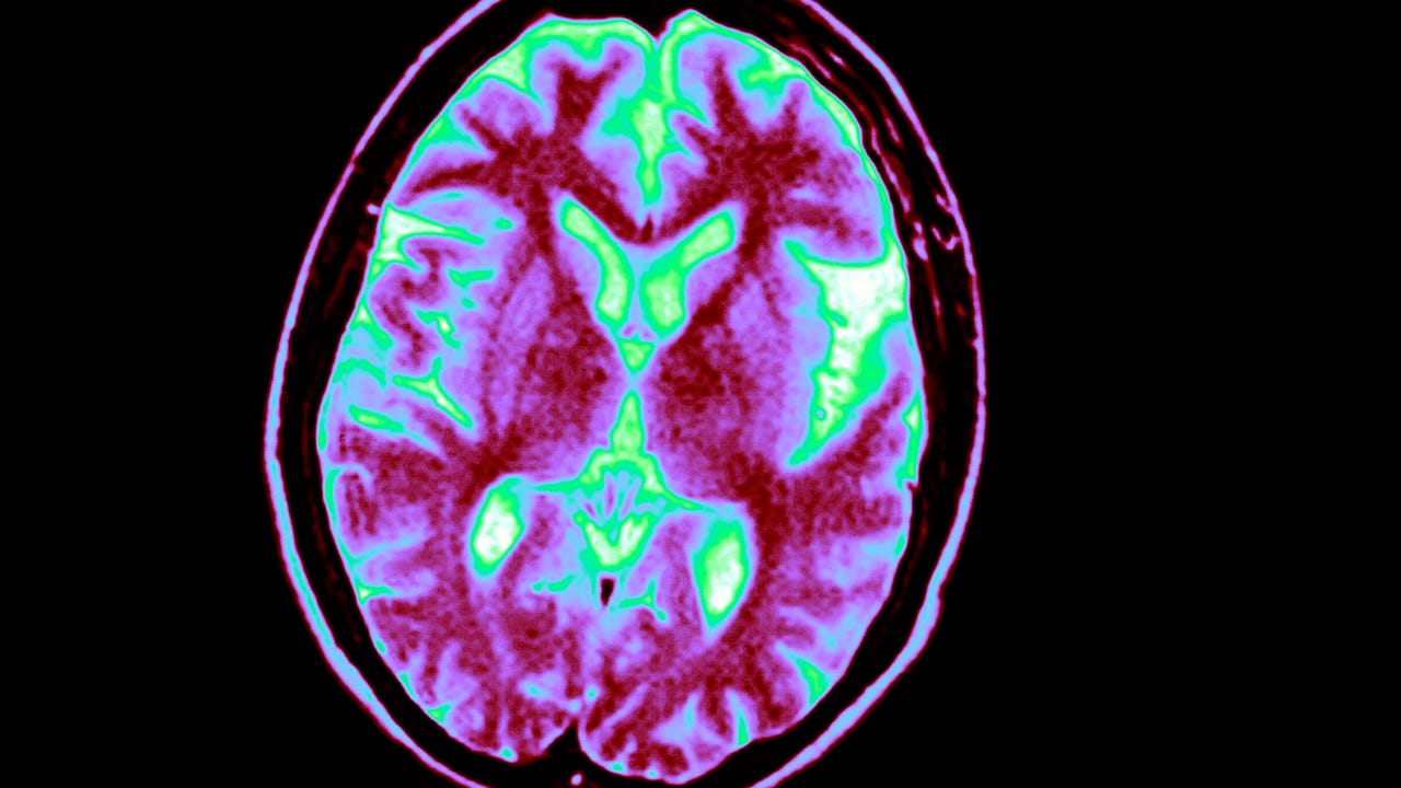First Alzheimer's disease risk assessment blood test for consumers hits market - Vimarsana News