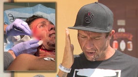 Man surfing at New Smyrna Beach bitten in face by shark: 'Like a bear trap closing in on me'