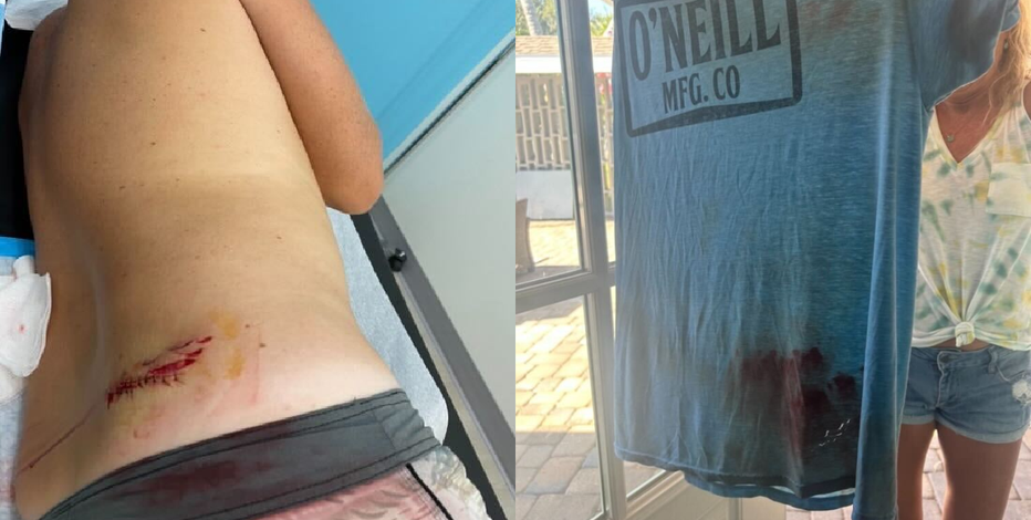2 surfers bitten by sharks at Central Florida beaches within 24 hours: 'I pushed my luck a little bit too far'