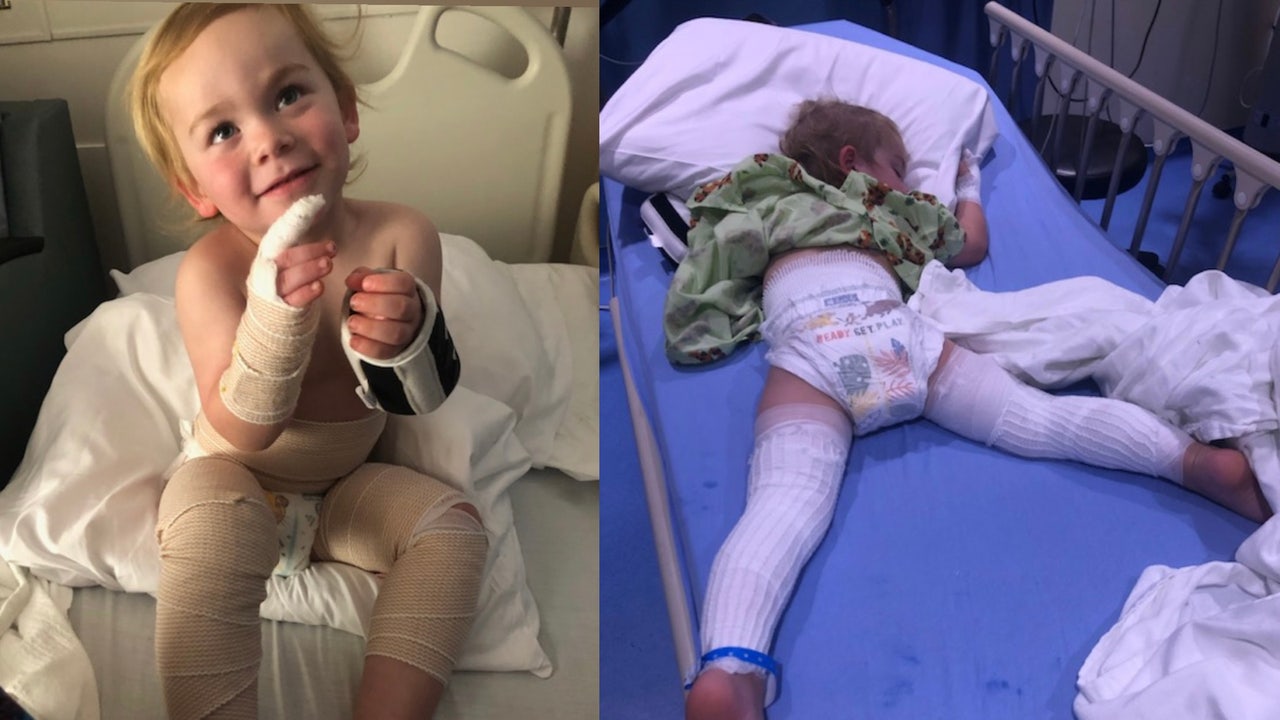 'His pants were melting': Florida boy recovering from burns after freak accident - Vimarsana News