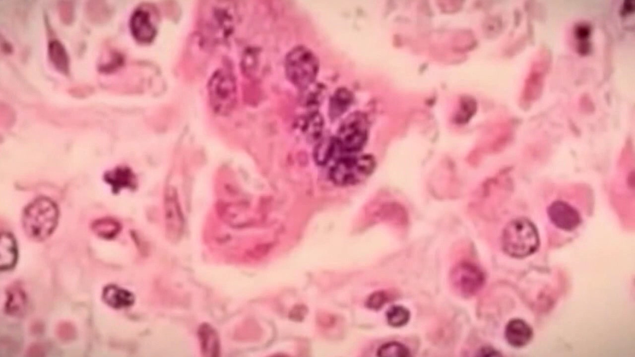 Florida's 9th case of measles confirmed in Polk County: Health officials - Vimarsana News