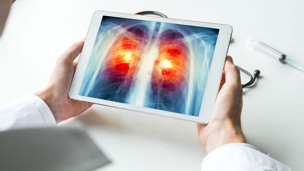 Just 18% of Americans who need lung cancer screenings get them