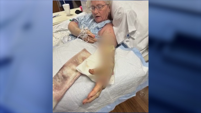 'Never even saw him': Central Florida woman nearly dies after being bitten by enormous snake