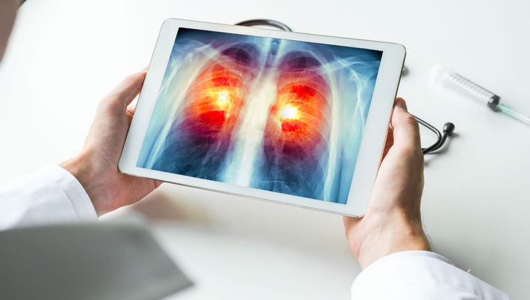 lung-screening-acs.jpg