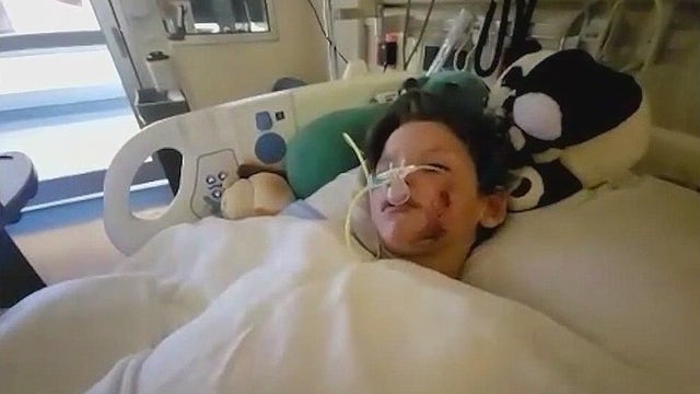 Campfire accident leaves 9-year-old Fruitland Park boy with burns to 40% of his body