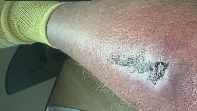 Rare bacterial infection strikes Florida man after Lake Dora Jet Ski injury