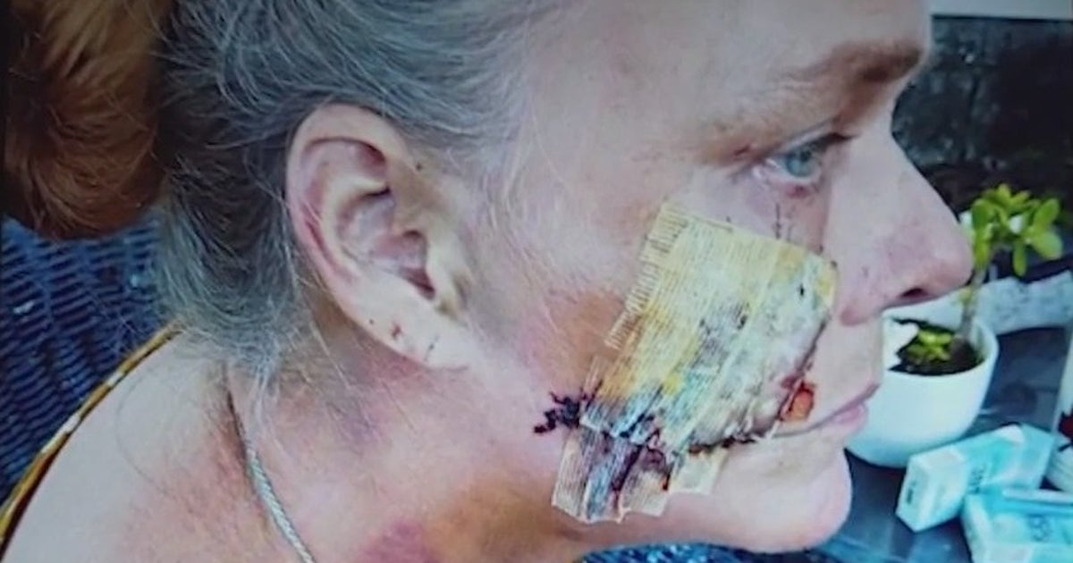 Caregiver recovering after dog mauling in Cocoa faces long road to ...