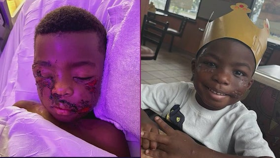 Vicious dog attack leaves 4-year-old Daytona Beach boy badly injured