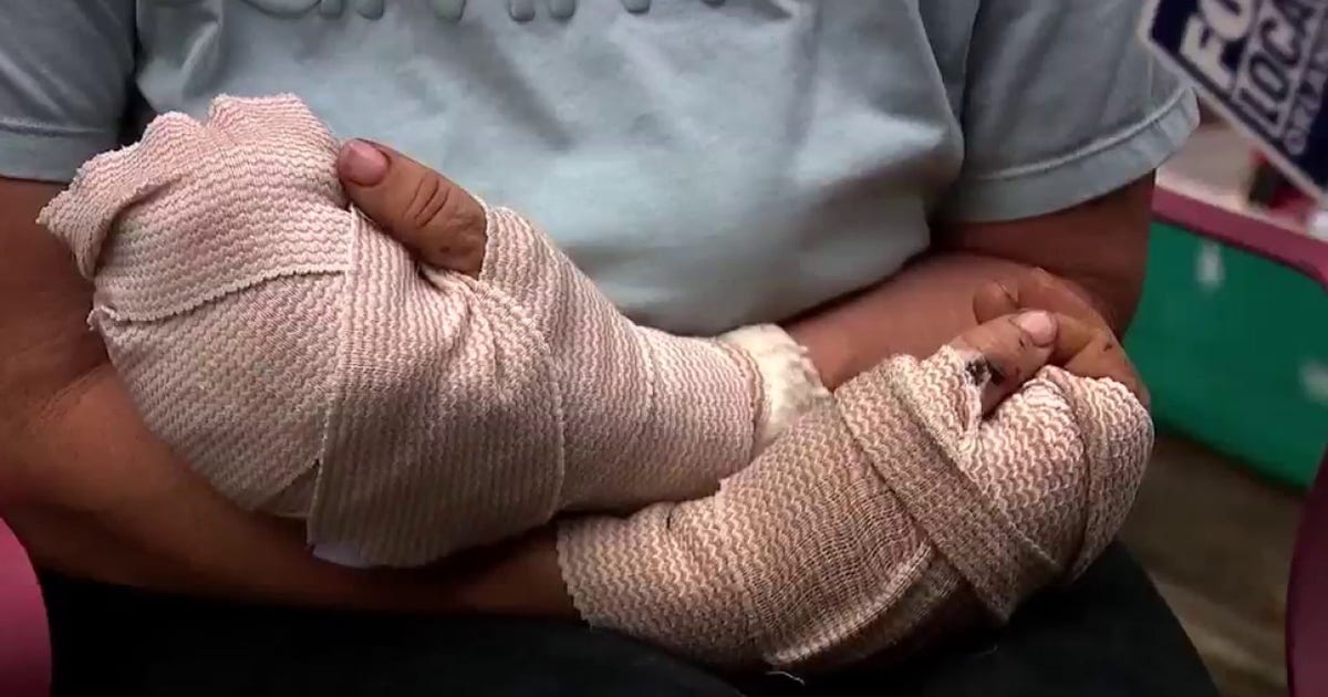 Osceola County woman recovering after dog attack in her front yard ...