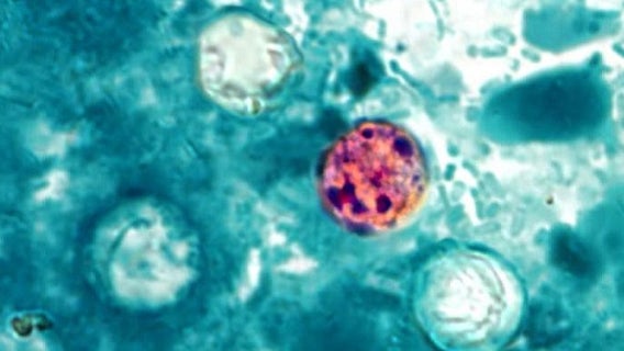 Cyclosporiasis outbreak: Florida cases up to 168; county-by-county breakdown