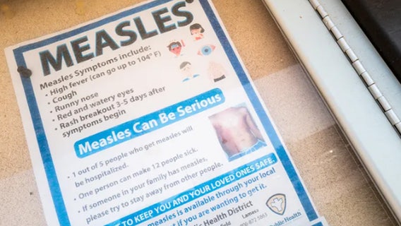 Measles surge hits new milestone as US cases surpass last year's total