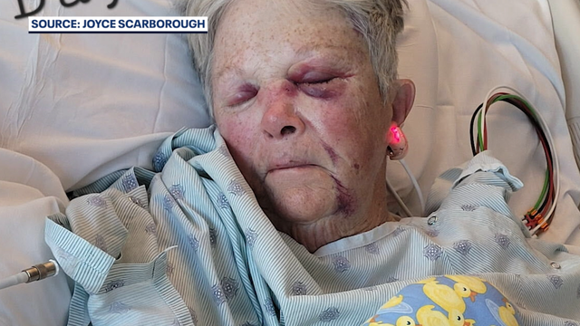Brevard County crossing guard relearns to walk, talk after being hit by SUV