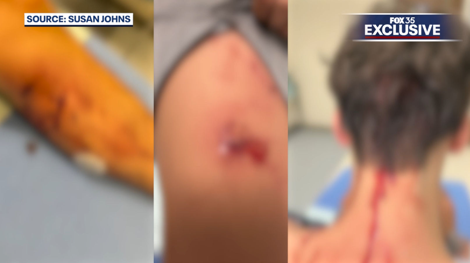 Teen recovering after attack by 5 dogs, father recounts desperate rescue