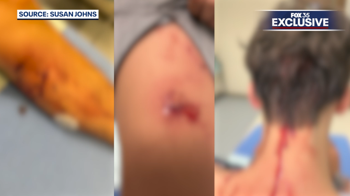 Teen recovering after attack by 5 dogs, father recounts desperate rescue