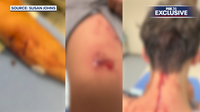 Teen recovering after attack by 5 dogs, father recounts desperate rescue