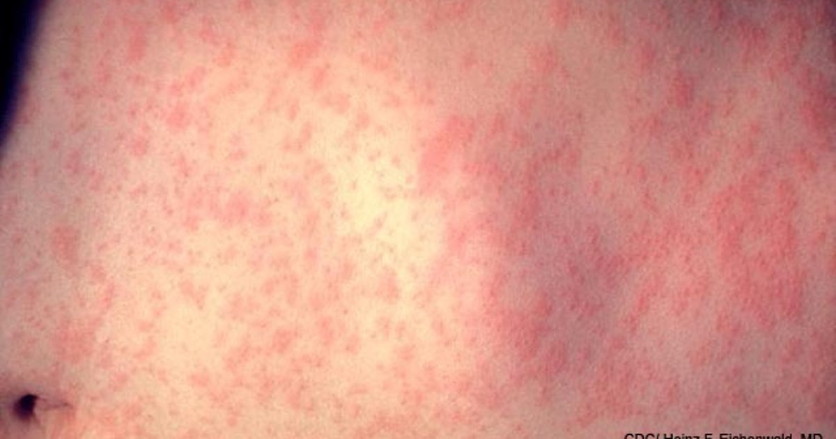 Texas measles outbreak 2025: State identifies 20 new cases, state total ...