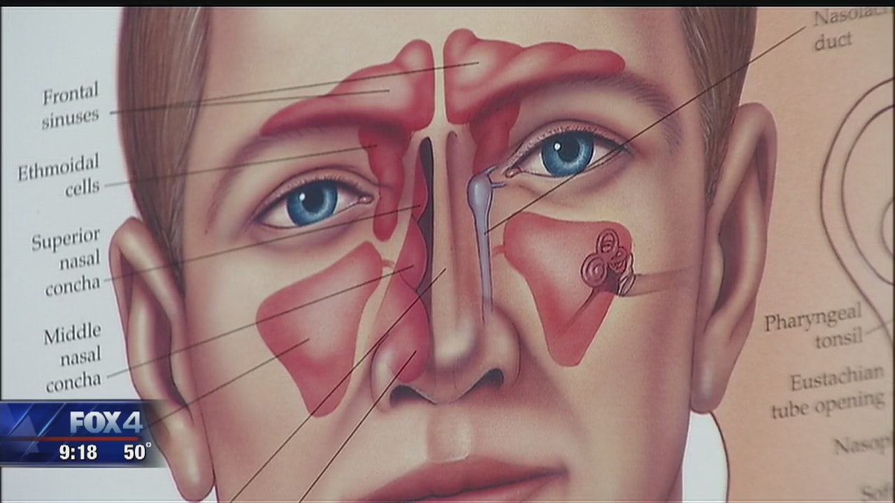 What to Know About Cedar Fever FOX 4 DallasFort Worth