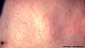 Texas measles outbreak 2025: State identifies 20 new cases, state total climbs to 561