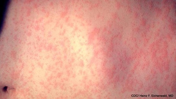 Possible measles exposure reported at Frisco Walmart